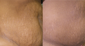 Melanopeel photo 2